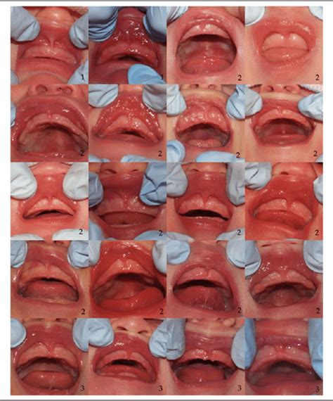 large labial folds